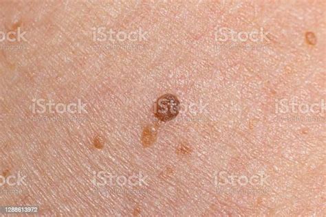 Papilloma On Human Skin Benign Tumor In The Form Of Mole Nevus