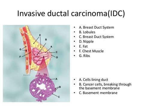 Invasive Ductal Carcinoma New Health Advisor