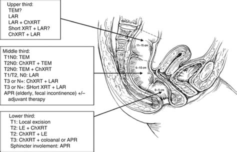 Surgical Treatment Of Rectal Cancer Abdominal Key