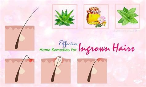 The area around the infected ingrown hair may. 16 Effective Home Remedies For Ingrown Hairs Cyst ...