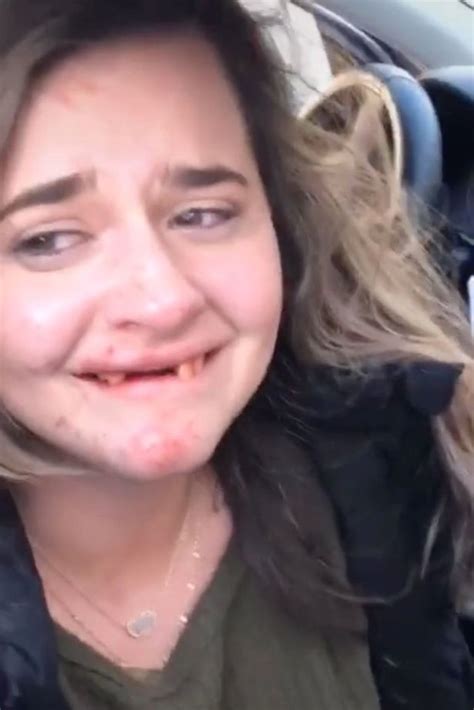 Woman In Tears After Smashing Her Front Teeth From Having Too Many