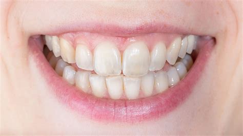 Thinning Enamel How To Spot Enamel Loss And Damage