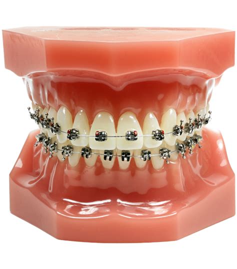 Braces Png Free File Download Png Play