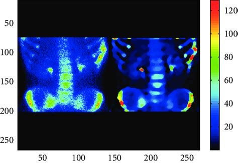 Bone Scintigraphy A Standard Scintigraphic Image Left Image Is