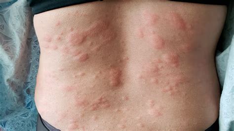Nine Different Skin Allergy Types And What They Meannine Different Skin Allergy Types And What