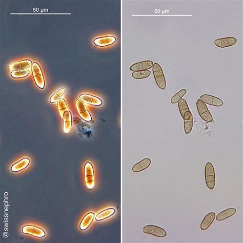 Contamination Of Urine With Fungal Spores Cladosporium