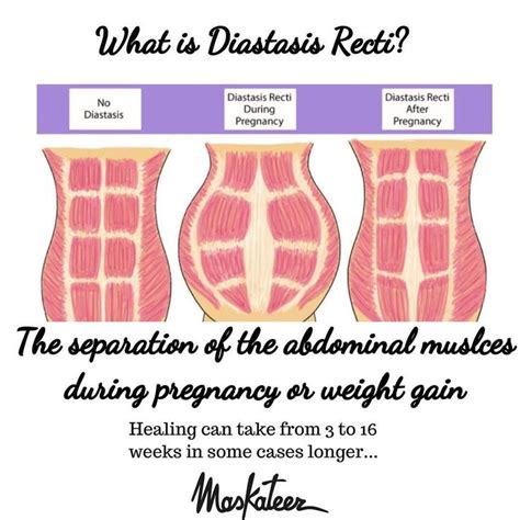 Heal Your Diastasis Recti With Maskateer Brings The Stretched Muscle