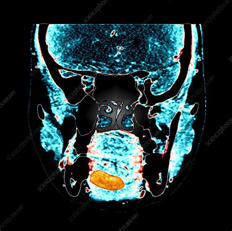 Lingual Thyroid Ct Scan Stock Image C0271861 Science Photo Library