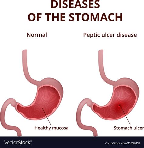 Anatomy Of The Human Healthy And Unhealthy Stomach