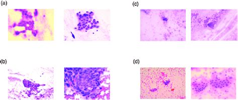 Cell Brushing Cytology Results Of The Biliary Tract A True Positive