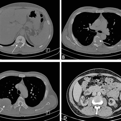Axial Ct Scan Of The Chest And Abdomen Expansile Lytic Lesion At T12