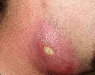 Sometimes they just look like small red pimples with no discharge, while other times they may be filled with yellow pus and blood or cause large bumps or lumps under the skin can be hidden under the skin. Ingrown Hair Bump Pictures, Cyst, Boil, Under Skin, Hard ...