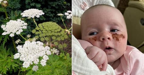 Baby Burned By Giant Hogweed When Sister Laid Pretty Flowers In Her