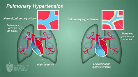 Pulmonary Hypertension St Vincents Heart Health