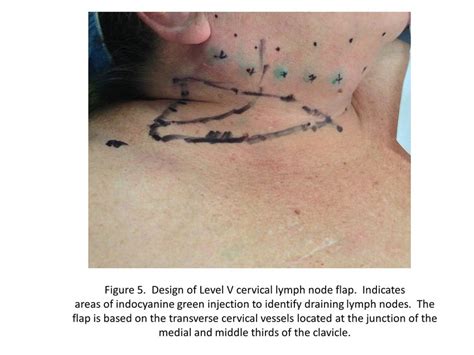 Design Of A Planned Cervical Lymph Node Flap Level V Based On