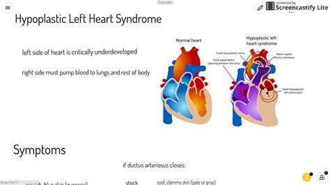 Hypoplastic Left Heart Syndrome Wikipedia