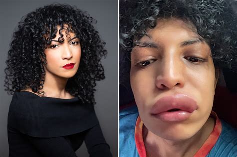 This Womans “kiss Of Death” Shows Just How Serious Allergic Reactions