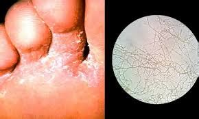Bisa akibat kosmetik, dampak setelah memakai cream, atau faktor lingkungan. gatal gatal berair di telapak kaki