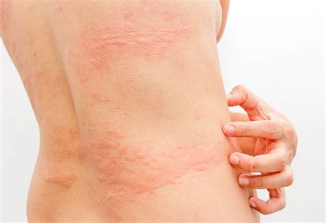 10 Most Common Skin Diseases And Skin Disorders Reviews And Appointment