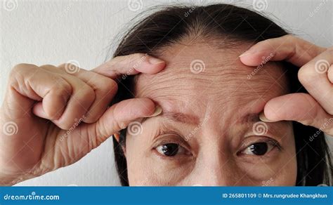 The Flabby Skin And Cellulite Under The Eyes Wrinkle And Ptosis Beside