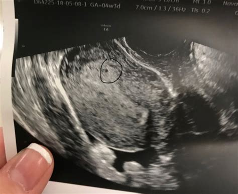 4 Week Ultrasound Babycenter