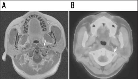 Mri A And Petct Bimages Of The Left Retropharyngeal Lymph Node
