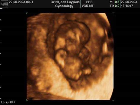 Une belle étape de son développement qui permettra bientôt aux parents de découvrir le sexe de bébé. La Troisième Grossesse de Mois - 3 mois enceintes | Dr N ...