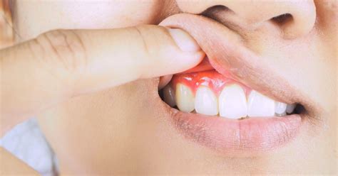 Gum Disease Primer Understanding Periodontal Disease Stages Factors