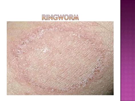 Most Common Skin Diseases Pictures Photos
