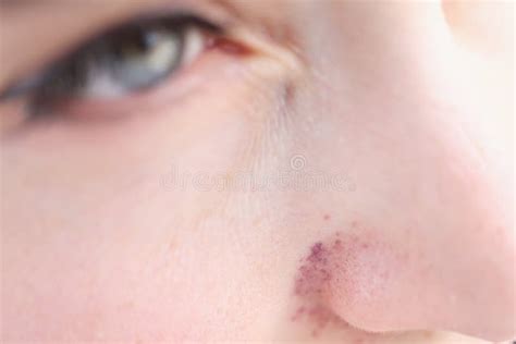 Red Cyanotic Rash On Woman Nose Closeup Stock Photo Image Of Skin