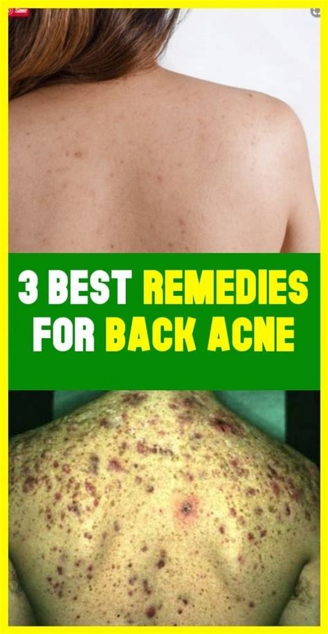 3 Best Repairs For Back Acne In 2020 Best Acne Remedies Back Acne