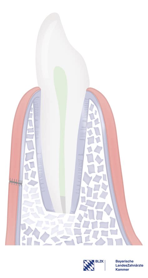 Wurzelspitzenresektion Wsr Zahnde