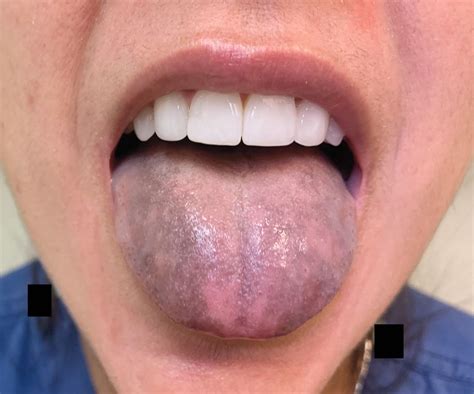 Tongue Discoloration Nejm Oral Health Health Science Healthcare
