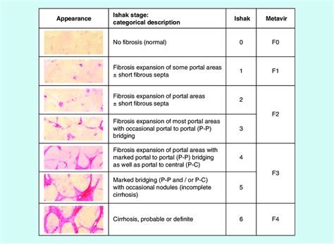 Histological Scoring System For Liver Fibrosis Reproduced With