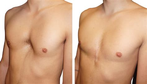 Pectus Excavatum Treatment Management Medical Care Surgical Care My