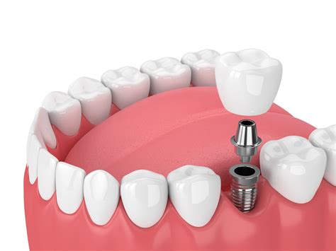 Single Dental Implants For A Missing Tooth Or Teeth Hoyesespecial