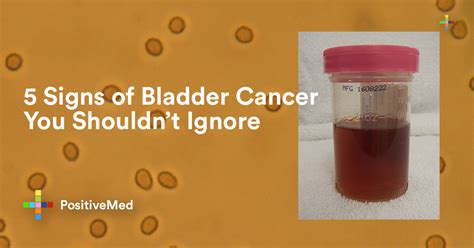 5 Signs Of Bladder Cancer You Shouldnt Ignore Positivemed