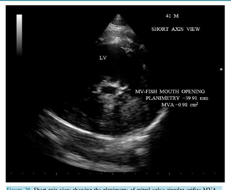 Rheumatic Aortic Valve Disease With Mitral Stenosisa Case Report My