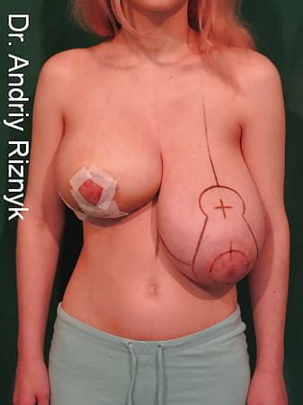 Erotic Abnormal Breasts Xxx Album