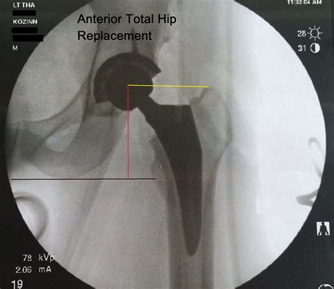 Anterior Hip Replacement Recovery Timeline Renew Physical Therapy