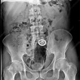 Foreign body in rectum, X-ray - Stock Image - C038/6646 ...