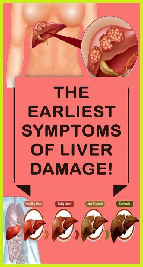Early Symptoms Of Liver Damage That Everyone Ignores Healthy Liver