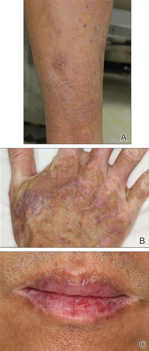 Crizotinib Induced Lichenoid Drug Eruption In A Patient With Lung