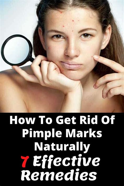 How To Get Rid Of Pimple Marks Naturally7 Effective Remedies In 2020