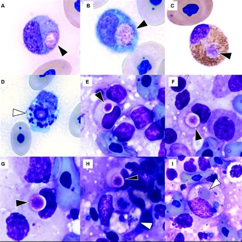Image Composite Of Inclusions Observed In Monocyteshistiocytes And