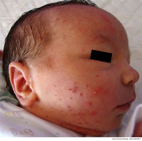 Transient Neonatal Pustular Melanosis Actas Dermo Sifiliográficas