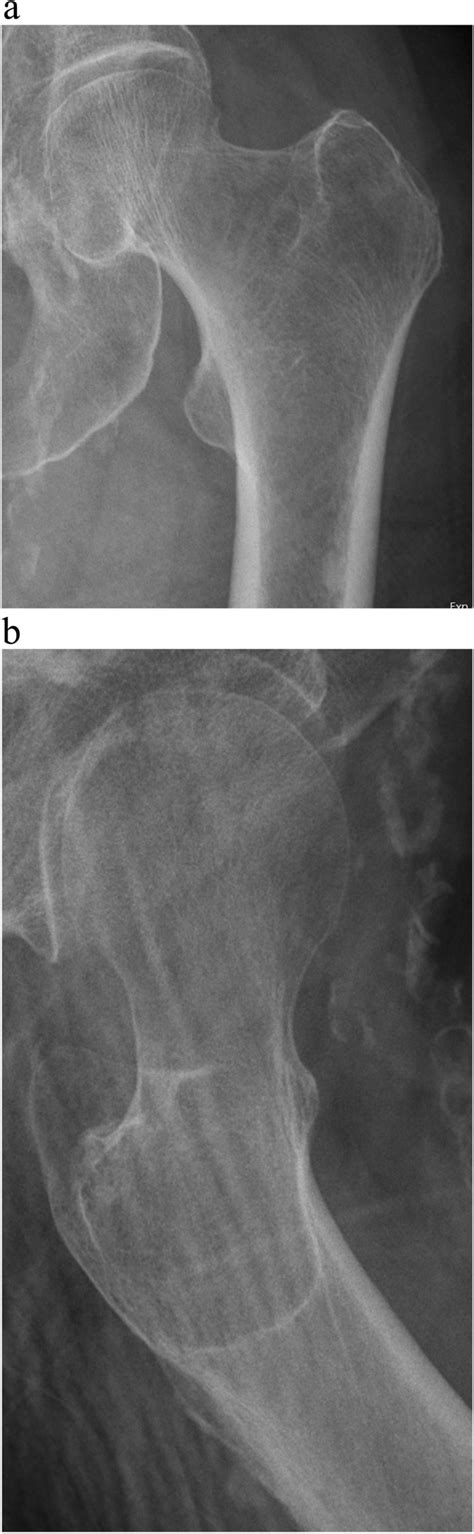 Plain Radiographs Of An Occult Femoral Neck Fracture A Ap Projection