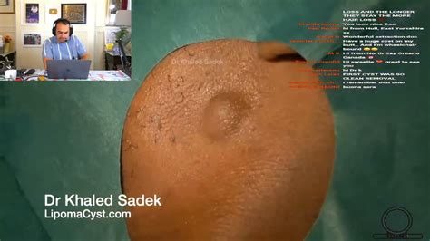 Cyst Removal Surgery Dr Khaled Sadek Youtube