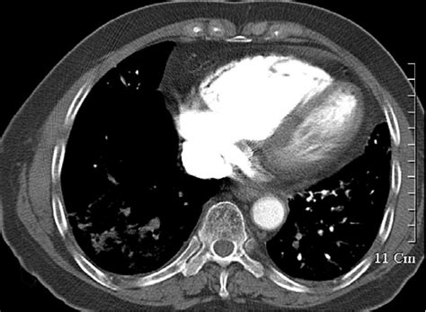 Ct Pulmonary Angiography Pulmonary Emboli Are Seen In Left Pulmonary
