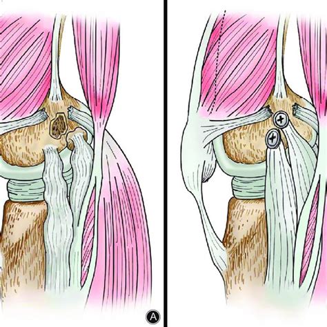 Pdf One‐stage Repair Of Posterior Oblique Ligament Avulsion Fracture